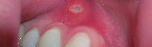 654 What Does Mouth Cancer Look 642x361 Side 1 642x200 - Oral Health Care During Cancer Treatments